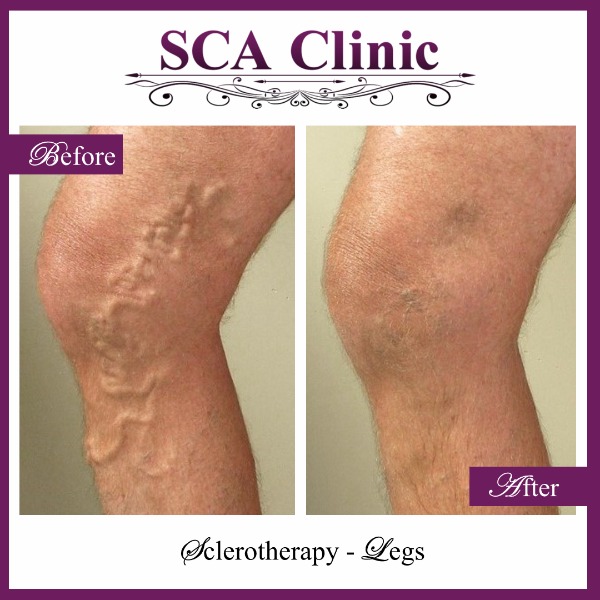 Sclerotherapy - Legs